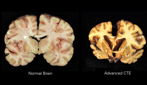 Normal brain compared to brain with CTE