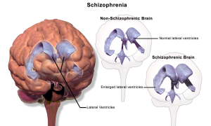 Schizophrenic Brain